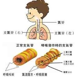 过敏性哮喘的最佳治疗方法